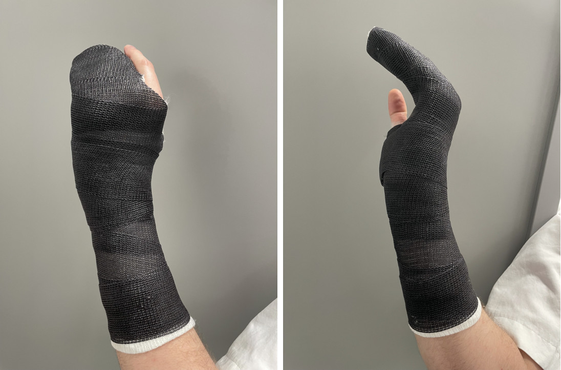 Sagitalbåndskade med subluksasjon av strekkesenen